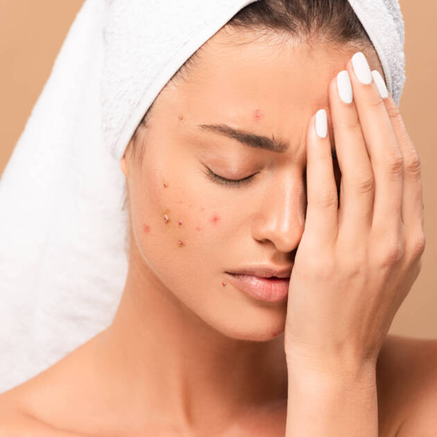 frustrated and nude girl with acne covering face isolated on beige